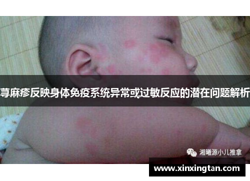 荨麻疹反映身体免疫系统异常或过敏反应的潜在问题解析 荨麻疹反映身体免疫系统异常或过敏反应的潜在问题解析