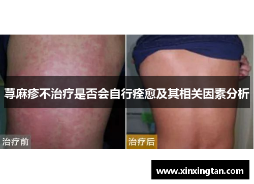 荨麻疹不治疗是否会自行痊愈及其相关因素分析 荨麻疹不治疗是否会自行痊愈及其相关因素分析