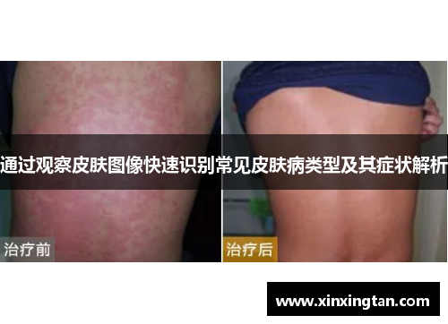 通过观察皮肤图像快速识别常见皮肤病类型及其症状解析 通过观察皮肤图像快速识别常见皮肤病类型及其症状解析